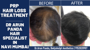 Read more about the article PRP Treatment to Stop Hair Loss | Hair Fall treatment in Vashi