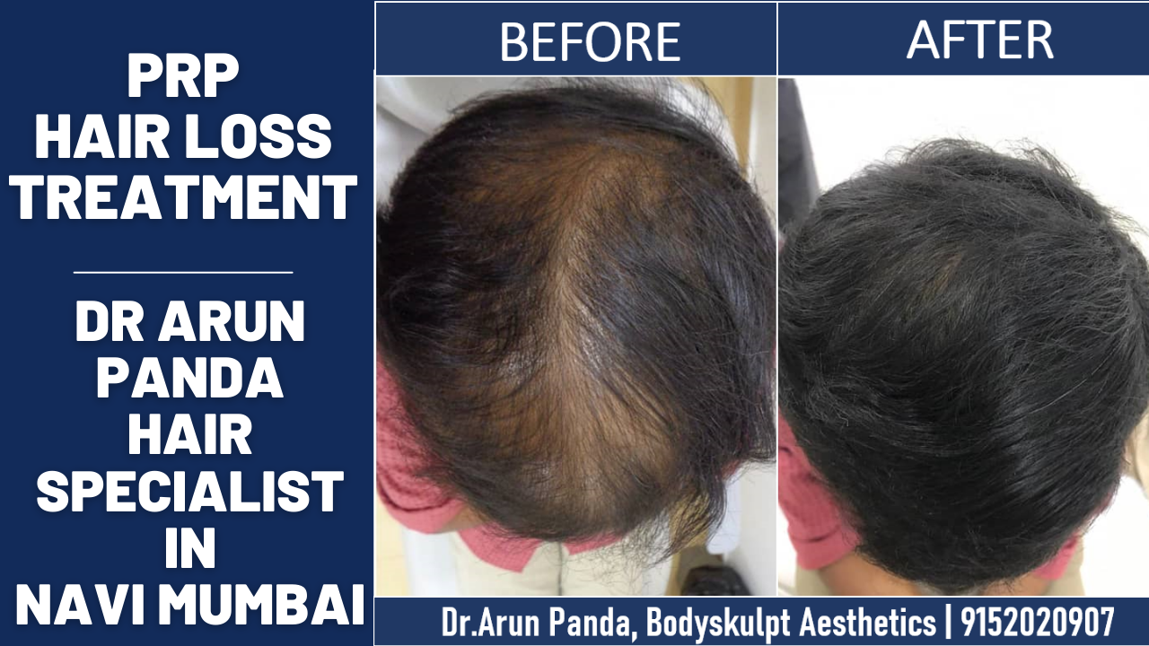 PRP Treatment to Stop Hair Loss | Hair Fall treatment in Vashi