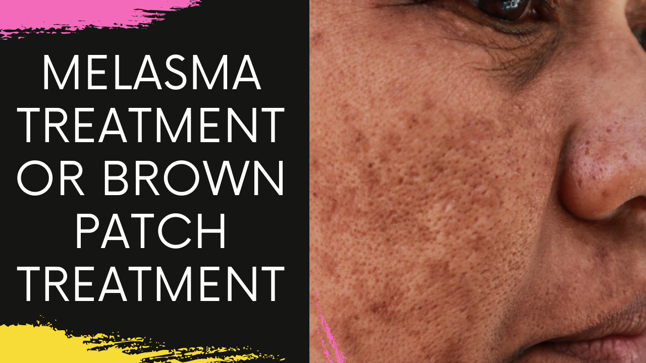 You are currently viewing Melasma treatment in Navi Mumbai