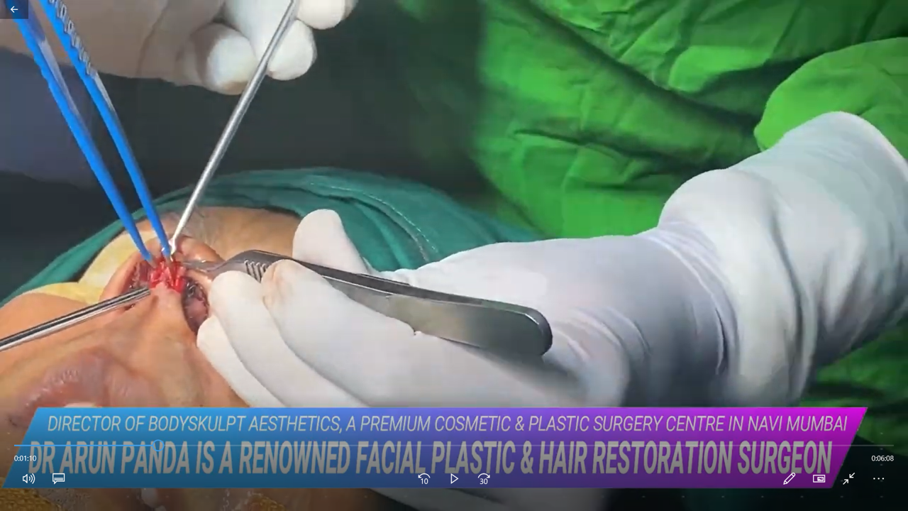 You are currently viewing What is Rhinoplasty and How does Nose Job Procedure work and What is the cost for Nose Reshaping