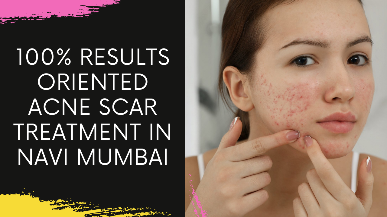 You are currently viewing Acne Scar Removal Treatment in Navi Mumbai | The Cost Of Acne Scar Treatment In Navi Mumbai