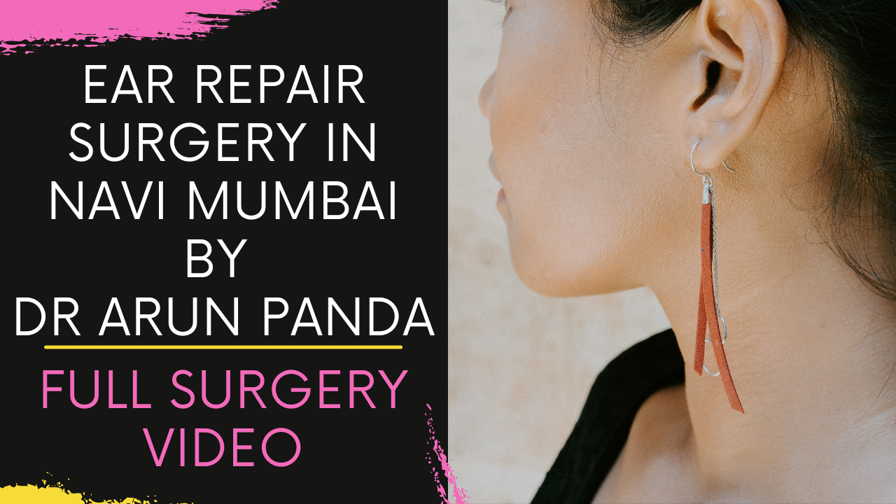 You are currently viewing Ear Repair Surgery in Navi Mumbai | Ear Repair Surgery in Mumbai | Elongated Earlobe Surgery