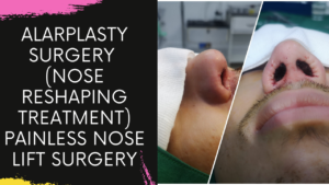 Read more about the article Alarplasty Nose Base Correction Surgery in Navi Mumbai by Dr Arun Panda