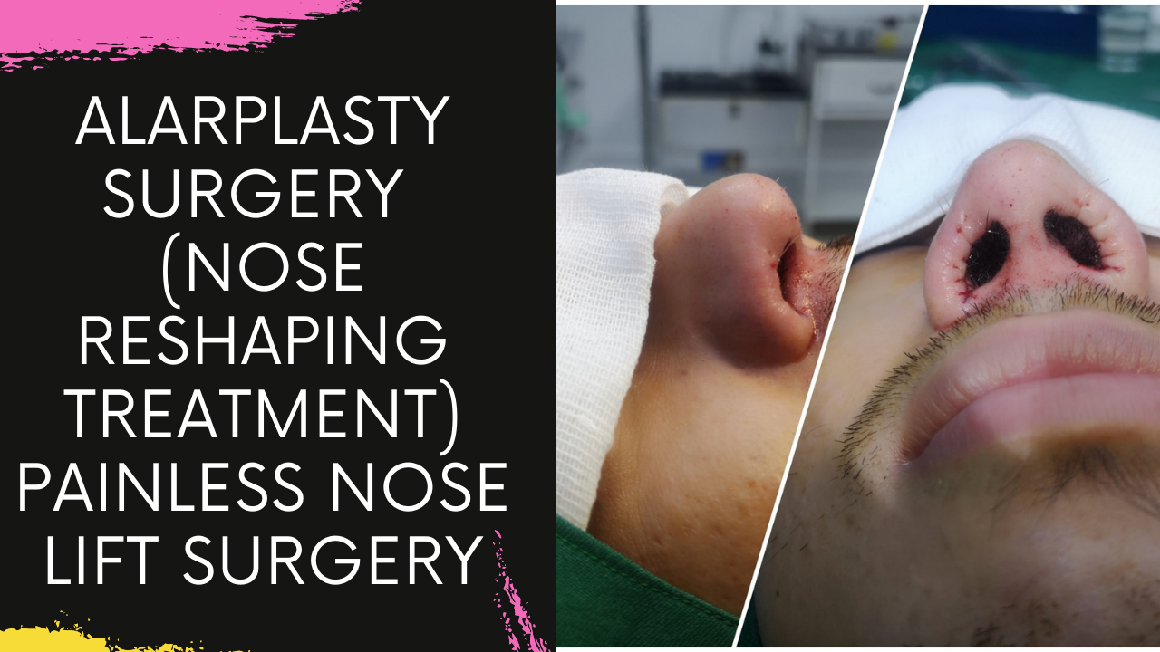 You are currently viewing Alarplasty Nose Base Correction Surgery in Navi Mumbai by Dr Arun Panda