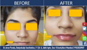 Read more about the article Lip Reshaping Treatment in Navi Mumbai – Cost, Procedure, Side Effects,  Learn everything about them.