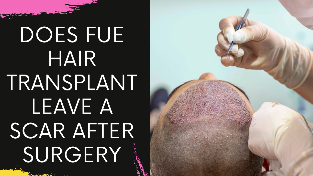 Read more about the article Does FUE Hair Transplant leave a scar after surgery explains Top Hair Transplant Surgeon in Mumbai
