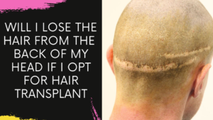 Read more about the article Will I Lose Hair from the Back of my Head if I opt for Hair Transplantation | Will it Grow back?