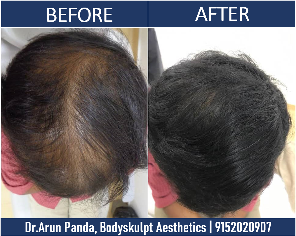 Hair Transplant in Navi Mumbai - Patient 11 Before and After