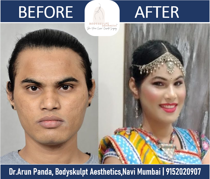 You are currently viewing Facial Feminization Surgery in Mumbai, India of a Transgender Patient