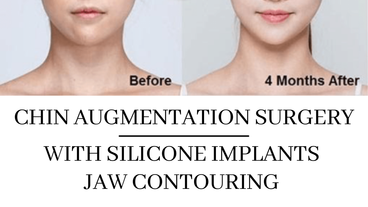 You are currently viewing Chin Augmentation Surgery in Navi Mumbai by Facial Plastic Surgeon Dr. Arun Panda