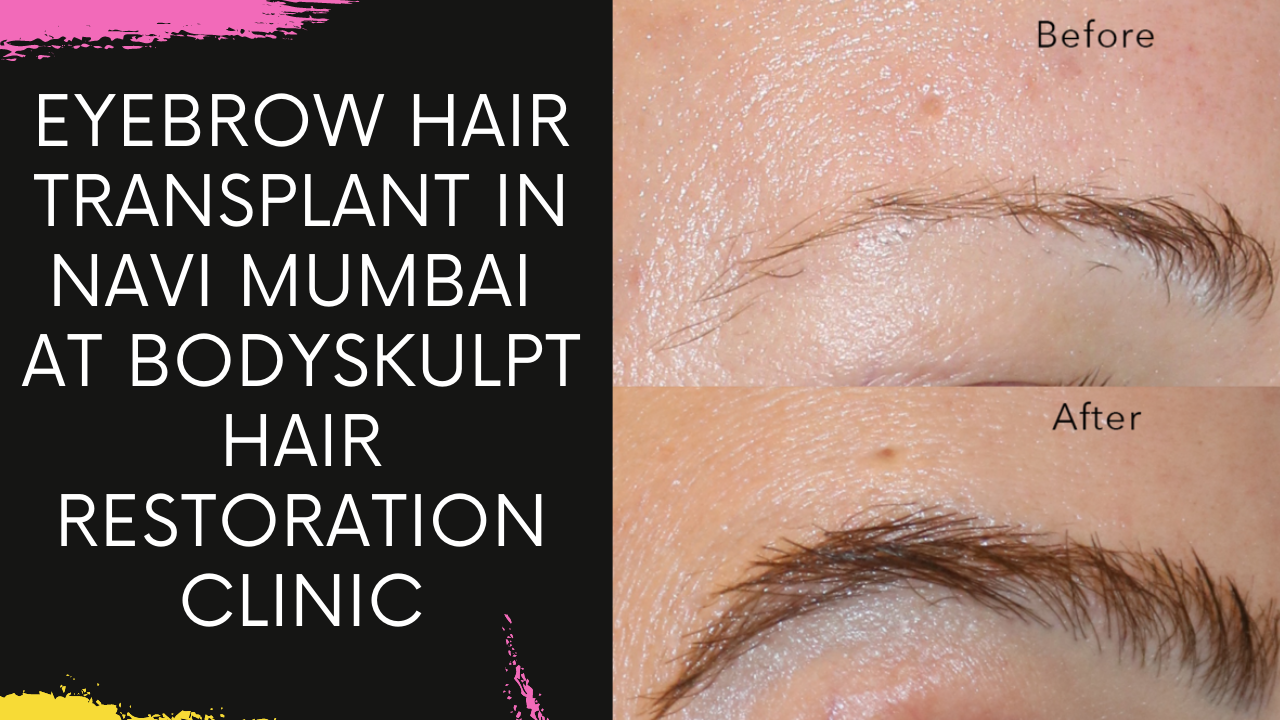 Read more about the article Eyebrow Hair Transplant in Navi Mumbai at Bodyskulpt Hair Restoration Clinic