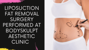 Read more about the article Liposuction Fat Removal Surgery performed at Bodyskulpt Aesthetic Clinic in Navi Mumbai