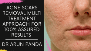 Read more about the article Best Acne Scar Treatment Navi Mumbai, Acne Scar Removal Treatment in Navi Mumbai