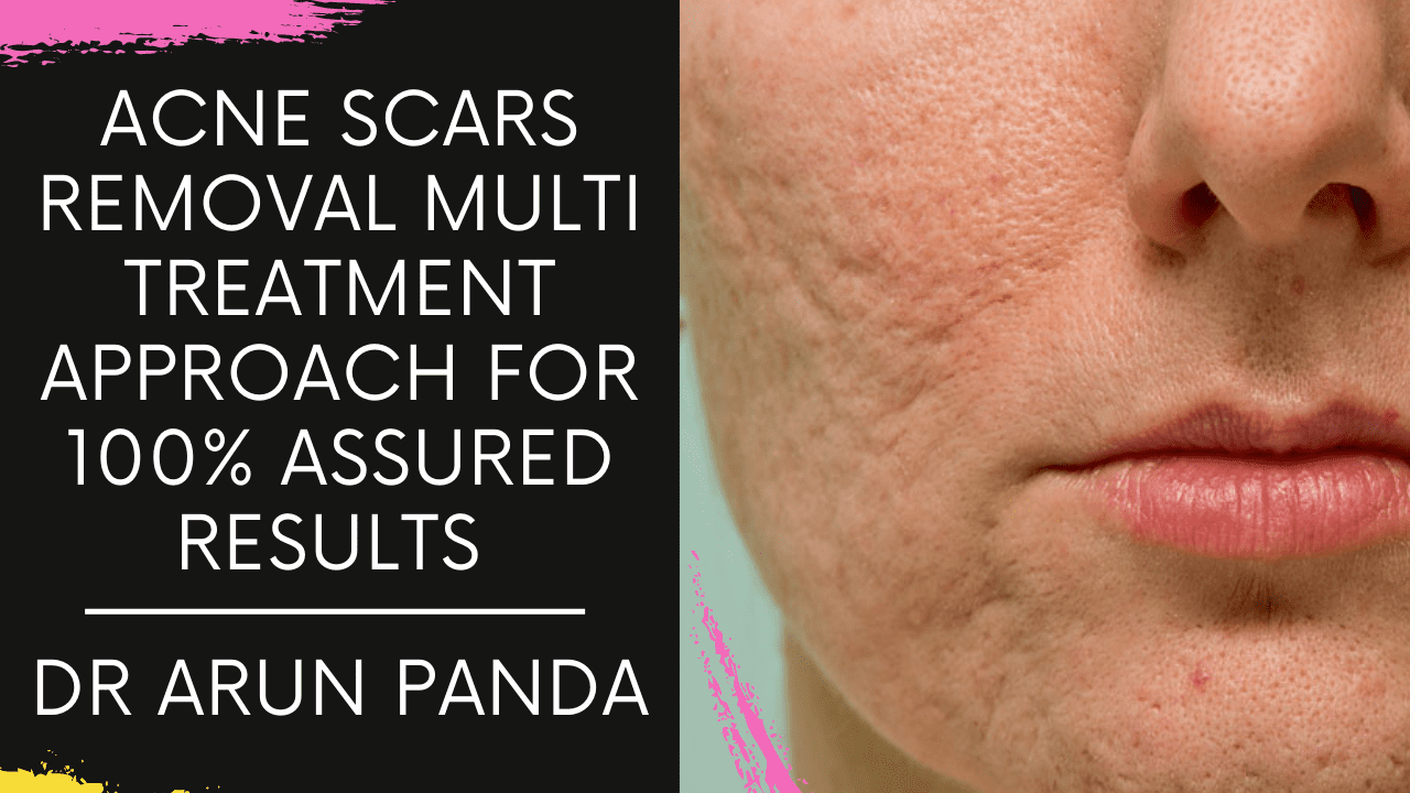 You are currently viewing Best Acne Scar Treatment Navi Mumbai, Acne Scar Removal Treatment in Navi Mumbai