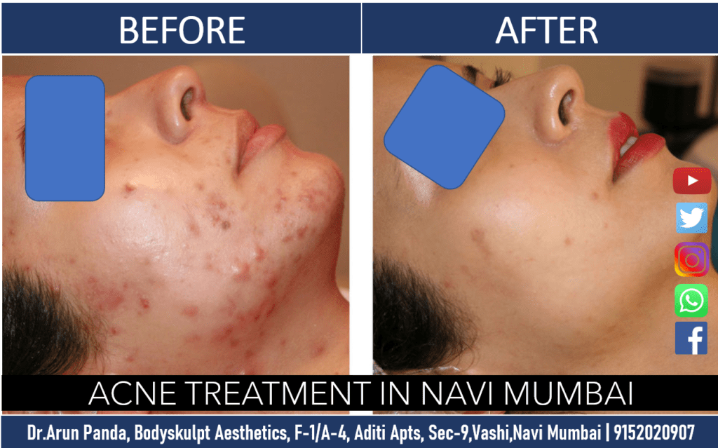 Cost of Acne Treatment in Navi Mumbai