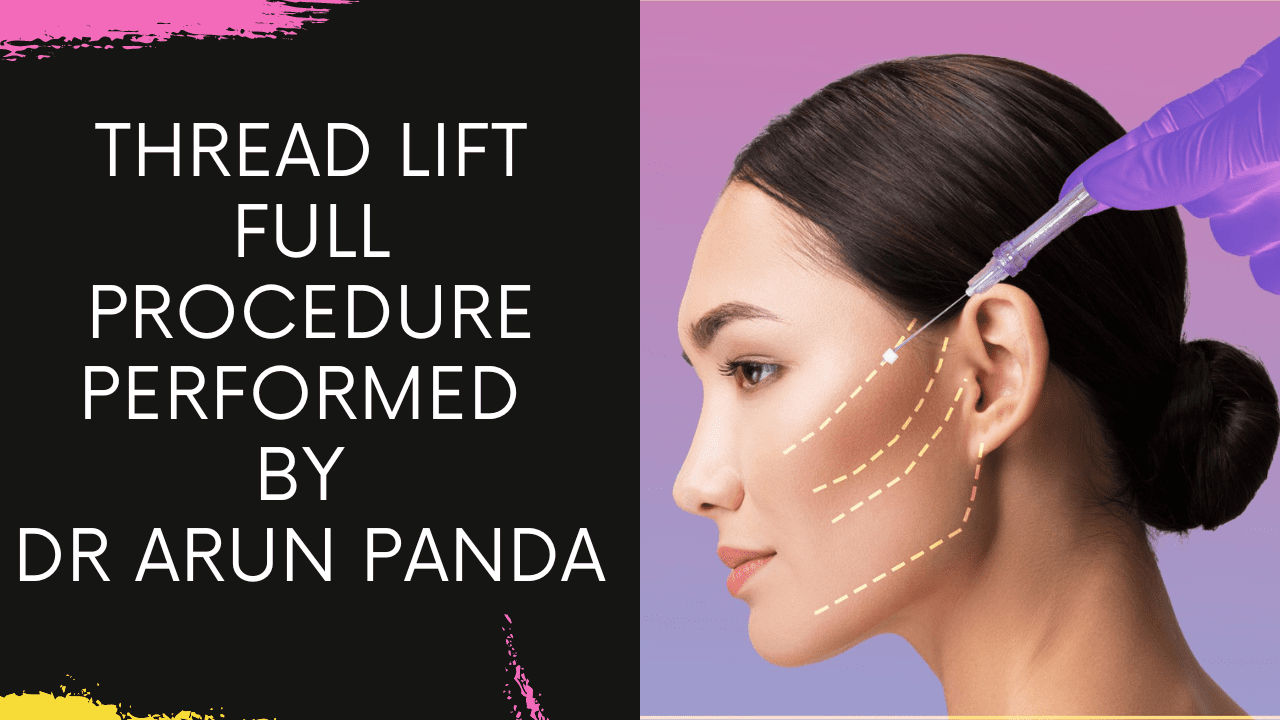You are currently viewing Thread Lift full Treatment | Procedure Performed by Dr Arun Panda Facial Plastic Surgeon