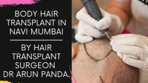 Read more about the article Body Hair harvesting for Hair Transplant for patient with less donor area in Navi Mumbai