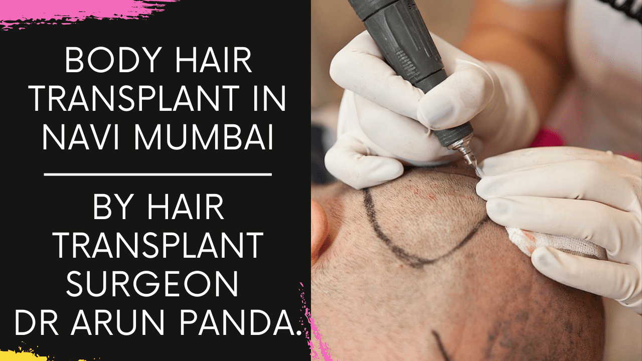 You are currently viewing Body Hair harvesting for Hair Transplant for patient with less donor area in Navi Mumbai