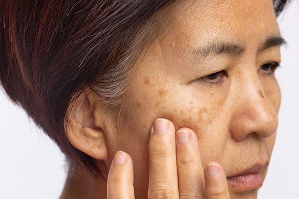 Read more about the article Cost of Melasma Treatment in Navi Mumbai