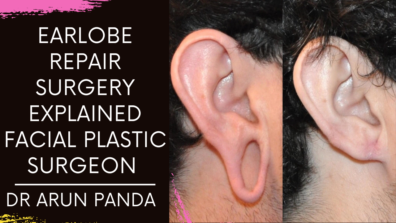 You are currently viewing Learn about Earlobe Repair Surgery explained Facial Plastic Surgeon Dr. Arun Panda