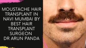 Read more about the article Moustache Transplant | What is Beard Balding? How are beard or mustache transplants performed?