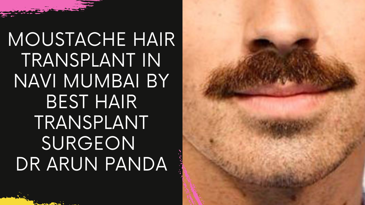 Moustache Hair Transplant in Mumbai by Best Hair Transplant Surgeon Dr Arun Panda