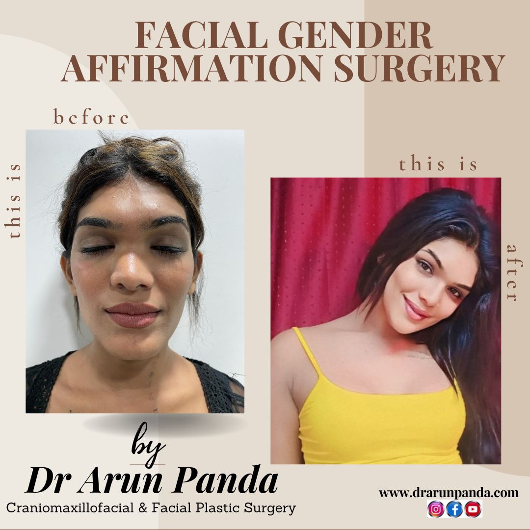 Facial gender affirmation surgery in India