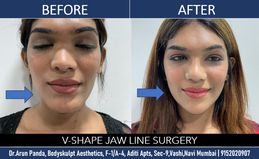 Jaw Surgery in Mumbai - Precision Facial Enhancement