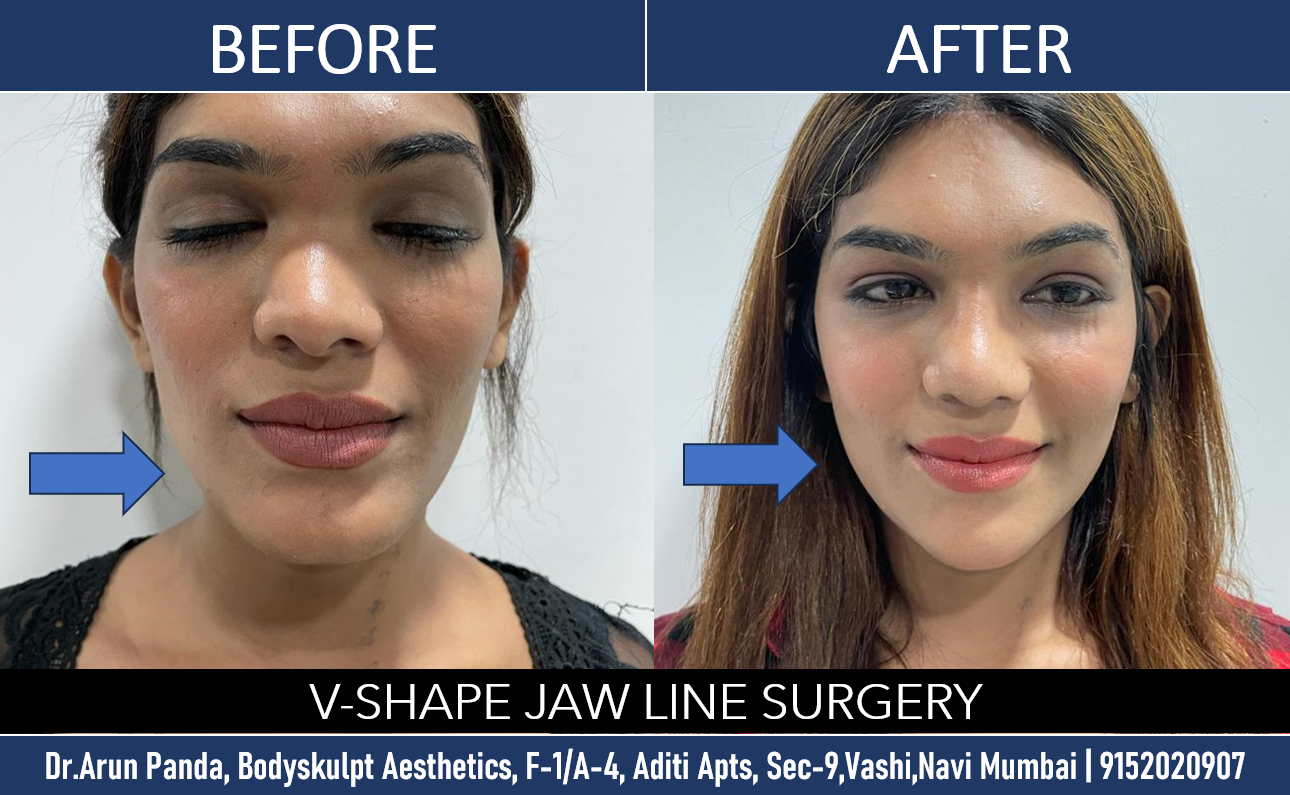 Read more about the article Achieving A Feminine V-Shape Jawline: All You Need to Know