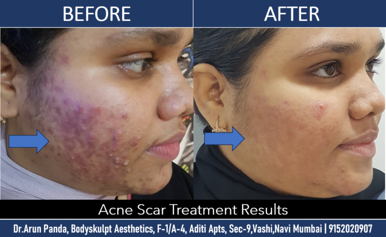 Effective Acne Scar Treatment in Navi Mumbai