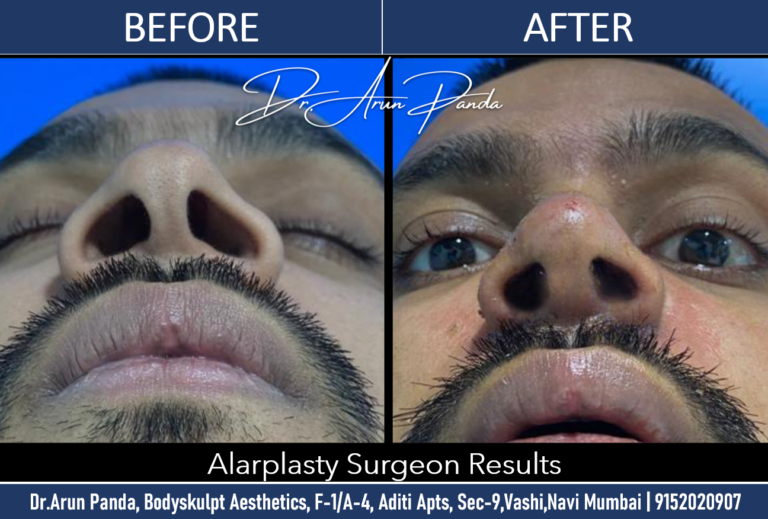 Leading Alarplasty Surgeon in Navi Mumbai for Refined Nasal Appearance