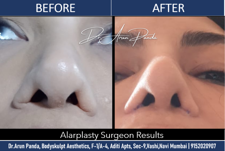 Expert Alarplasty Surgery in Navi Mumbai for Nasal Refinement