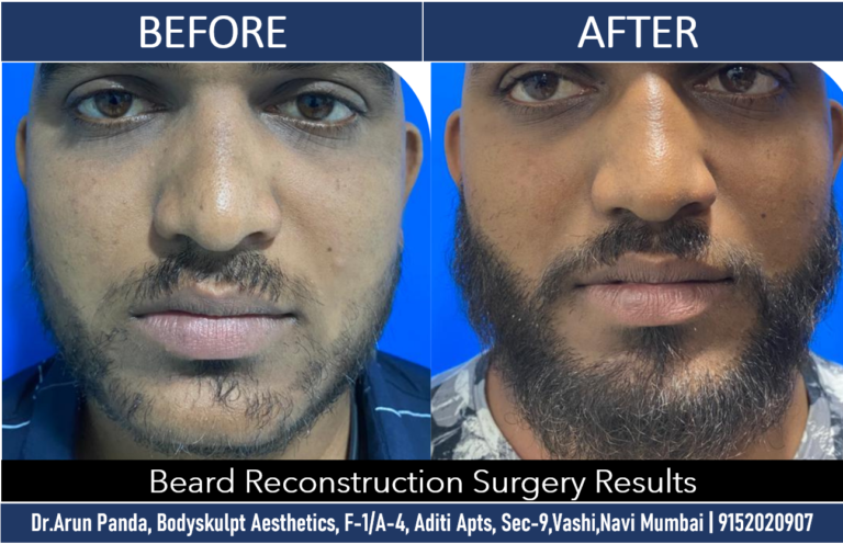 Navi Mumbai's Expert Beard Reconstruction Surgery