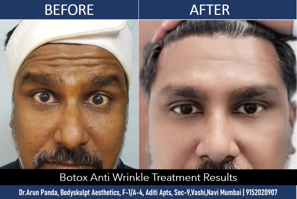 Anti Aging Treatment Mumbai, Wrinkles Treatment Cost India - The Esthetic  Clinics