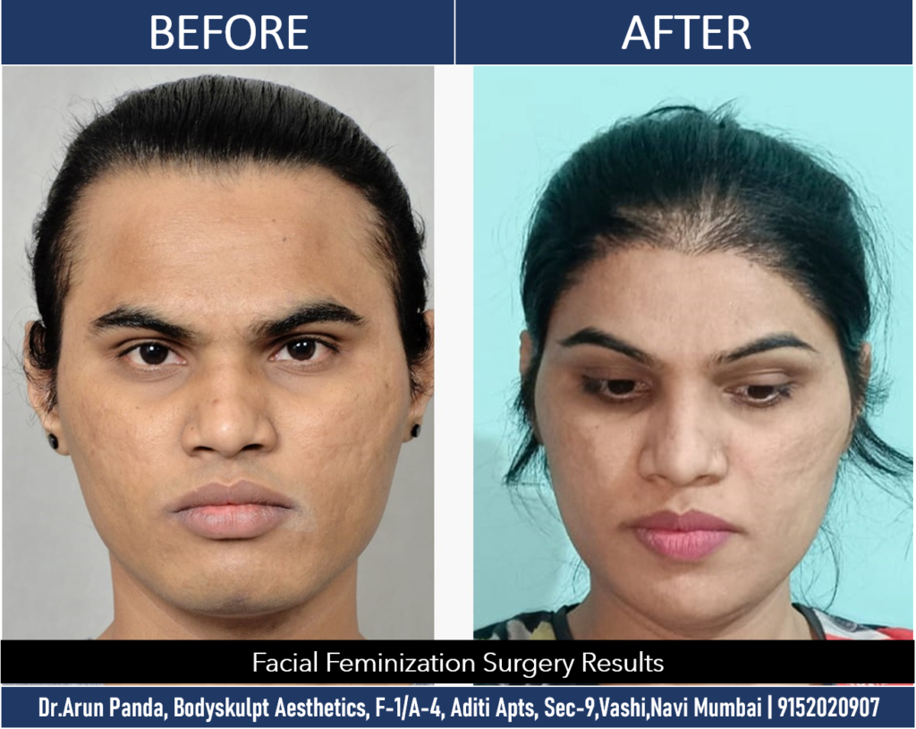 Elevate Your Feminine Features: Facial Feminization Surgery in India