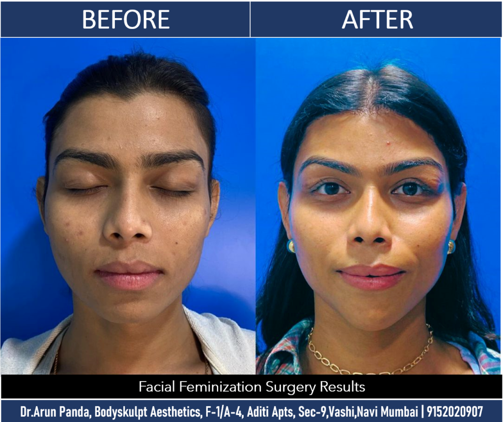 Experience the Best: Facial Feminization Surgery Results in India