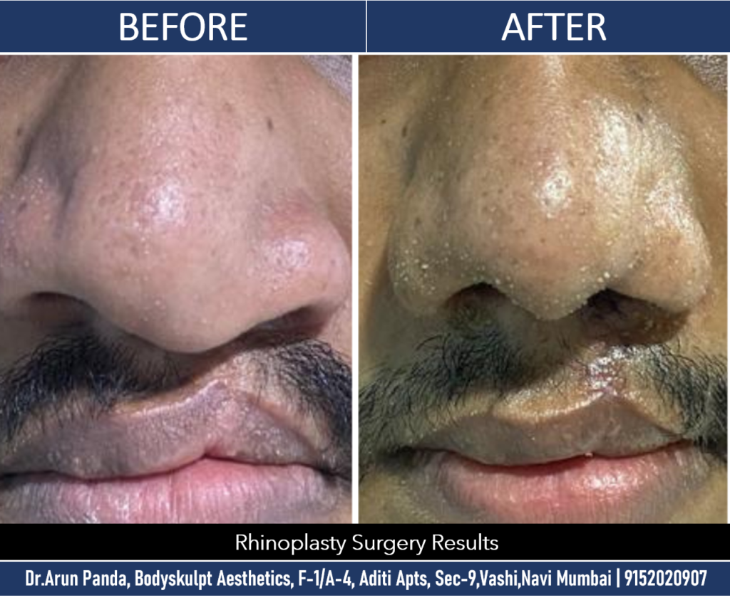 Top-Rated Rhinoplasty Surgeon in Mumbai for Beautiful Noses