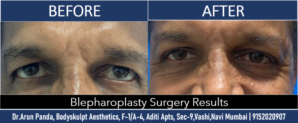 Transformative Blepharoplasty Surgery in Navi Mumbai