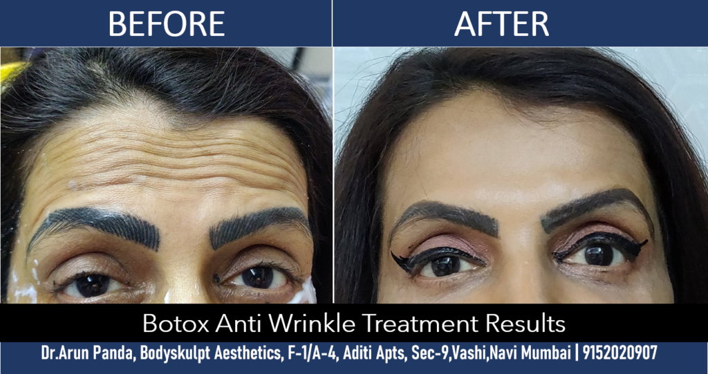 Navi Mumbai's Premier Botox Wrinkle Removal Treatment