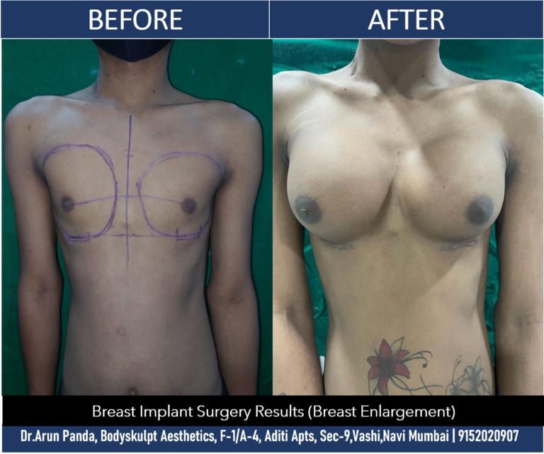Enhance Your Curves: Breast Enlargement Surgery in Navi Mumbai