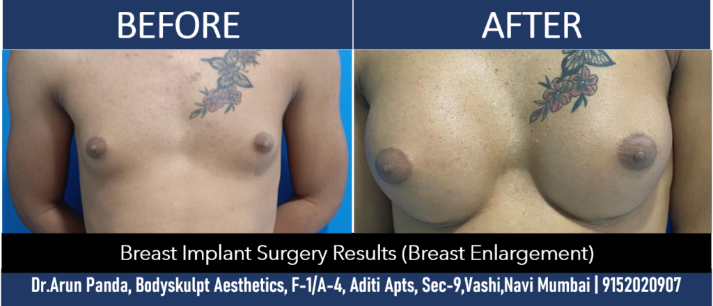 Enhance Your Feminine Silhouette: Breast Implant Surgery in Navi Mumbai
