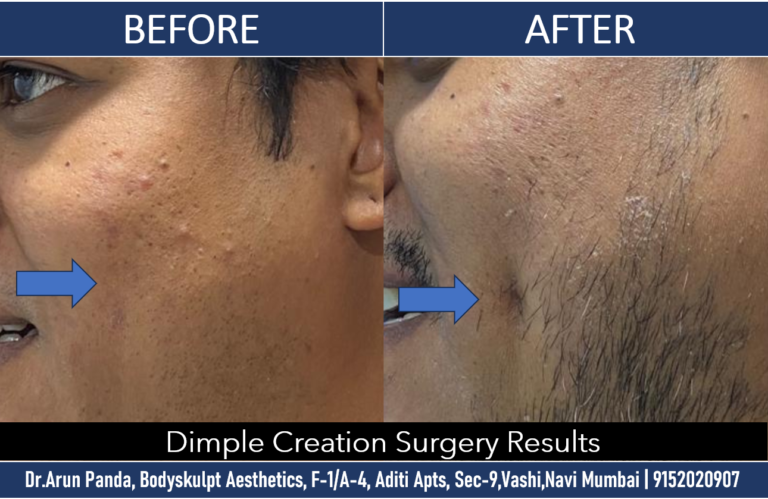 Artistic Dimple Creation Surgery in Navi Mumbai