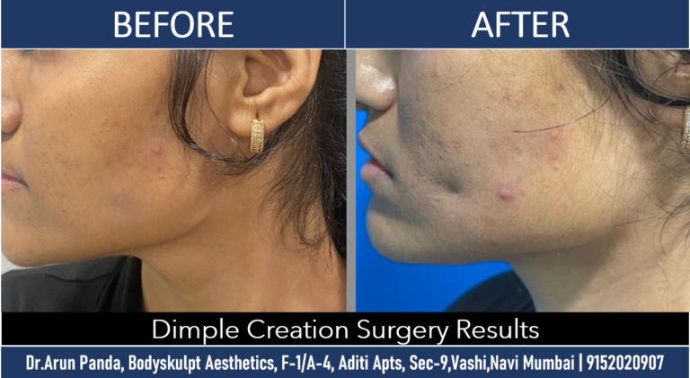 Navi Mumbai's Leading Dimple Creation Surgery Expertise