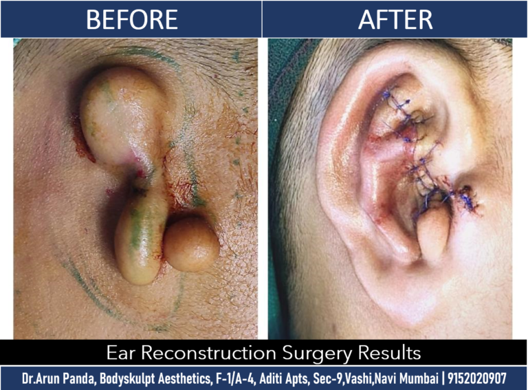 Expert Ear Reconstruction by Dr. Arun Panda, Mumbai Surgeon