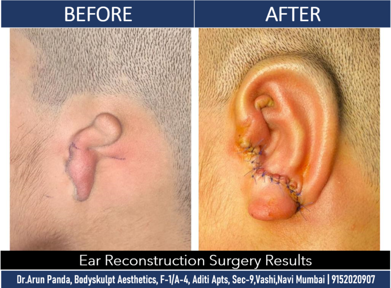 Navi Mumbai's Premier Ear Reconstruction Surgery Expertise