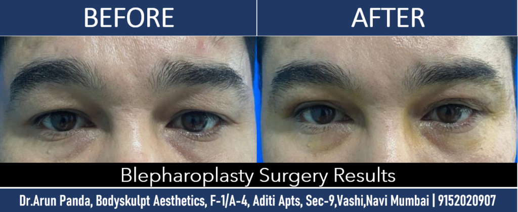 Enhance Your Look with Eyelid Surgery in Navi Mumbai
