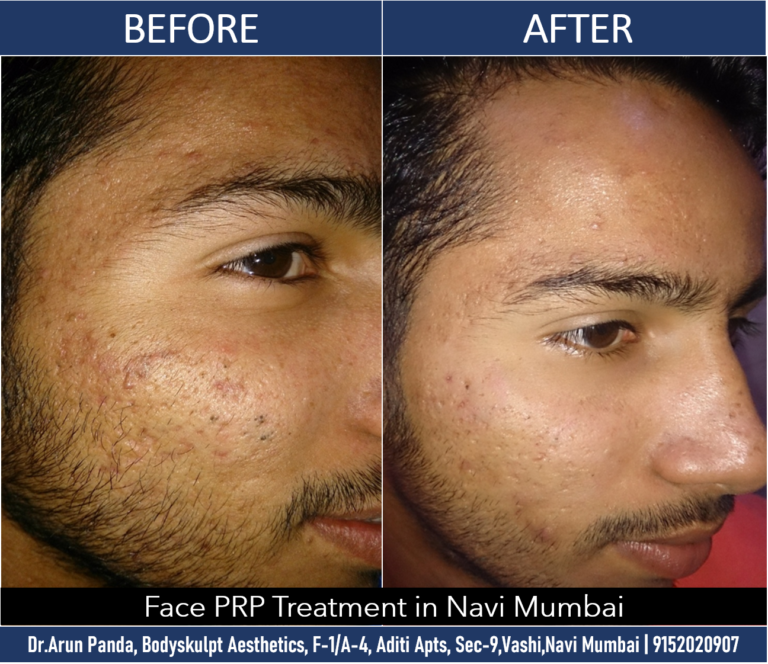 Revitalize Your Face with PRP Treatment in Navi Mumbai