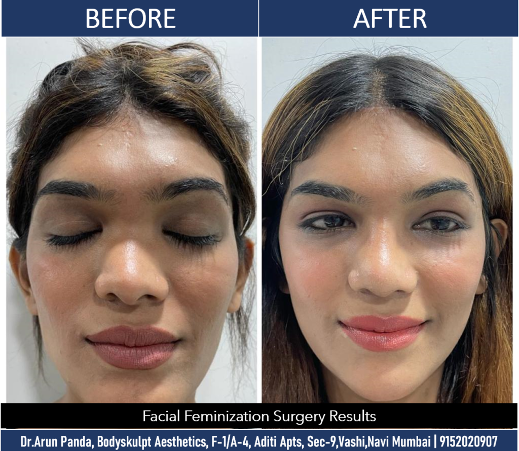 Expert Facial Feminization by Dr. Arun Panda in India