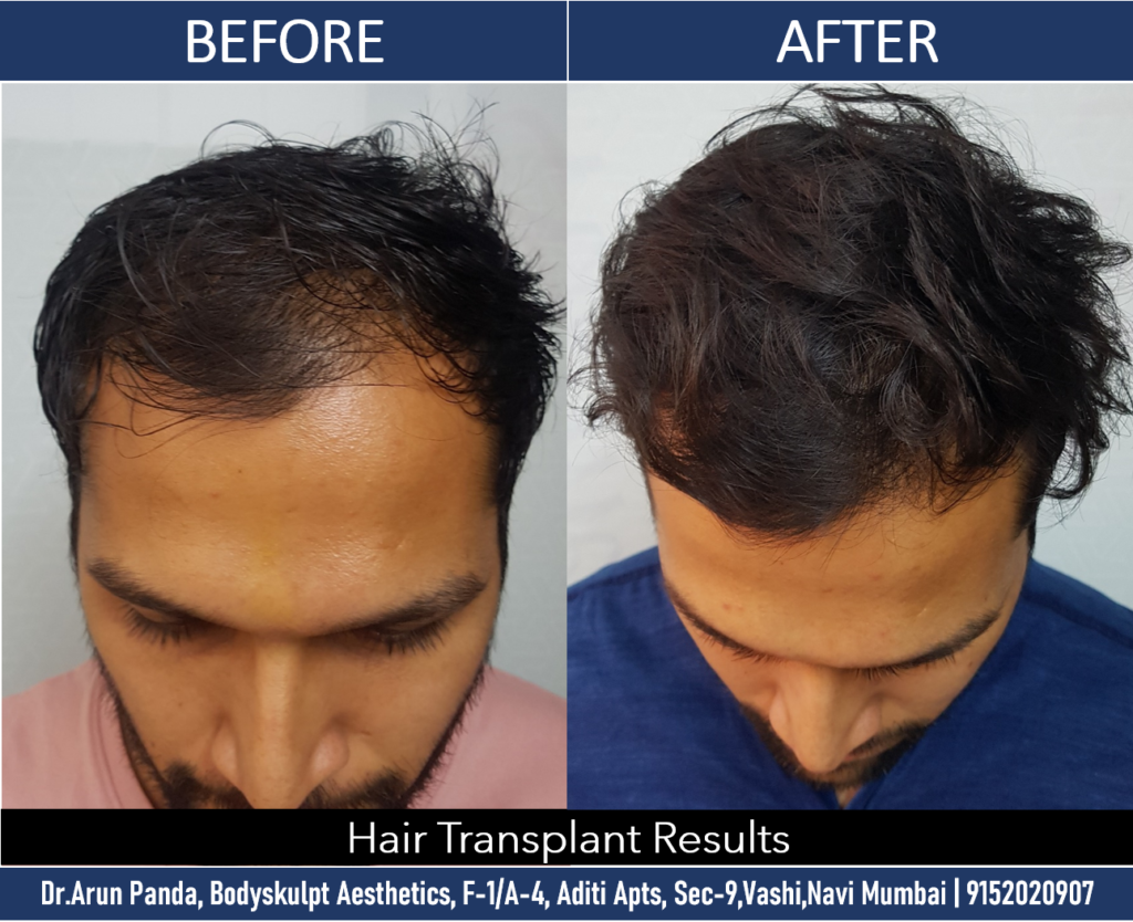 Effective Solutions for Hair Fall Treatment in Navi Mumbai