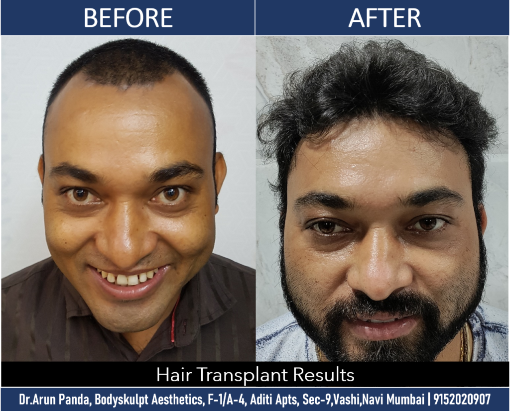 Transformative Hair Transplant Results in Navi Mumbai by Dr. Arun Panda